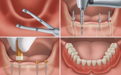 TRATAMIENTOS|  Rehabilitación completa mediante implantes