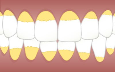 Sarro dental: Por qué se forma y cómo eliminarlo