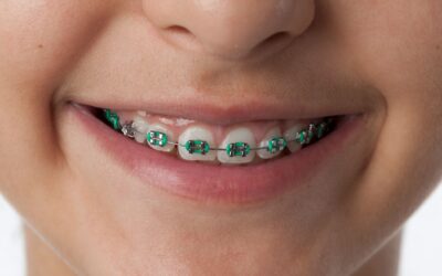 Tipos de brackets: ¿cuáles son los mejores?